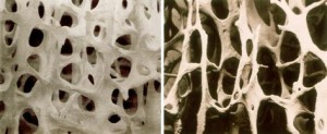 osteoporoza